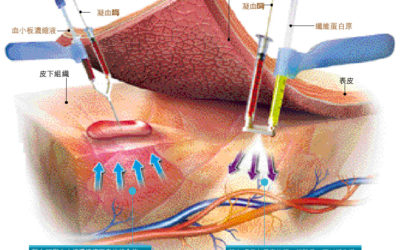 The forefront of medical treatment, a new weapon to restore:Hemostatic three-second glue